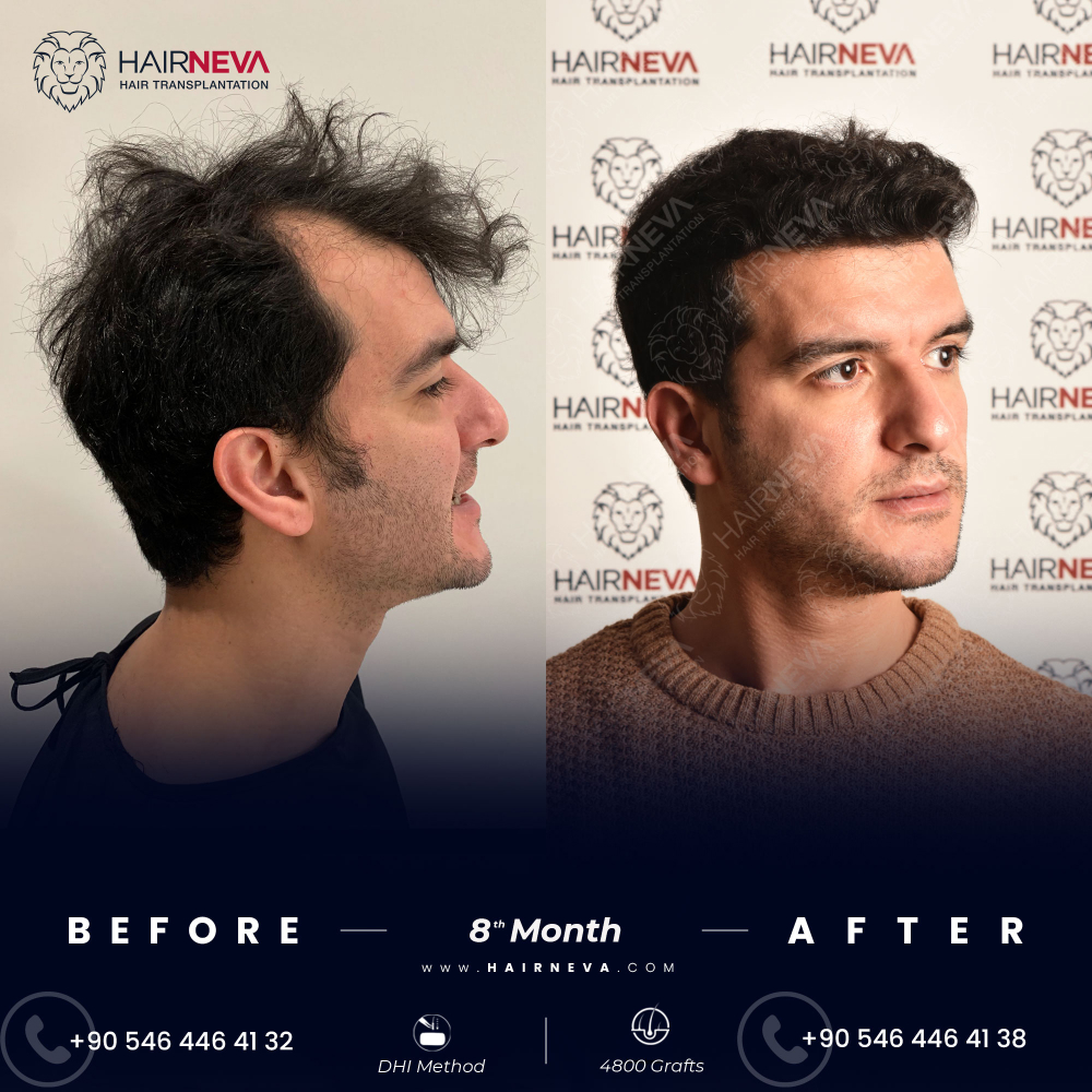 Hair Transplant Aftercare: Do's and Don'ts During Post-Transplant Stage