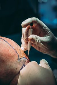 Hair Transplant Surgery Hair Transplant Procedure Hair Loss Treatment Direct Hair Implantation (DHI) Follicular Unit Extraction (FUE)