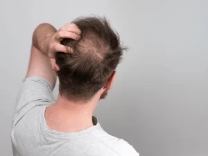 Microneedling for hair loss