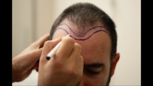 exercise after hair transplant