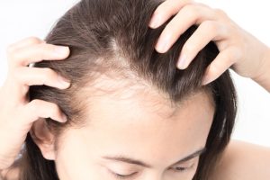 hair transplants for women