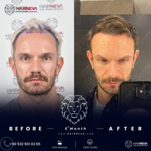 Hair Transplant Before and After Turkey