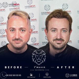 Hair Transplant Turkey for UK Patients
