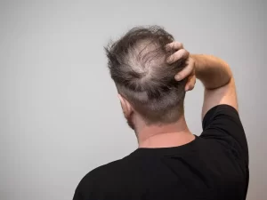 Permanent Hair Transplant