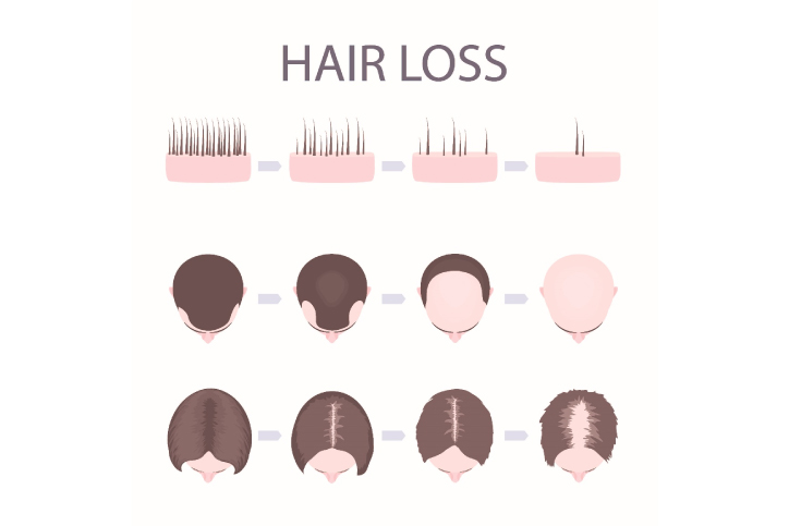 male vs female hair loss