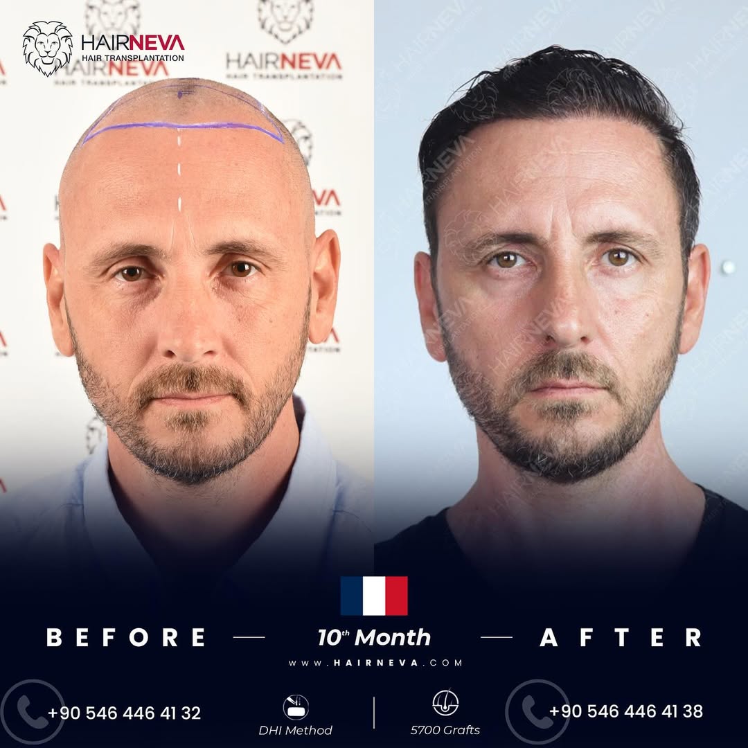 DHI Hair Transplant in Turkey