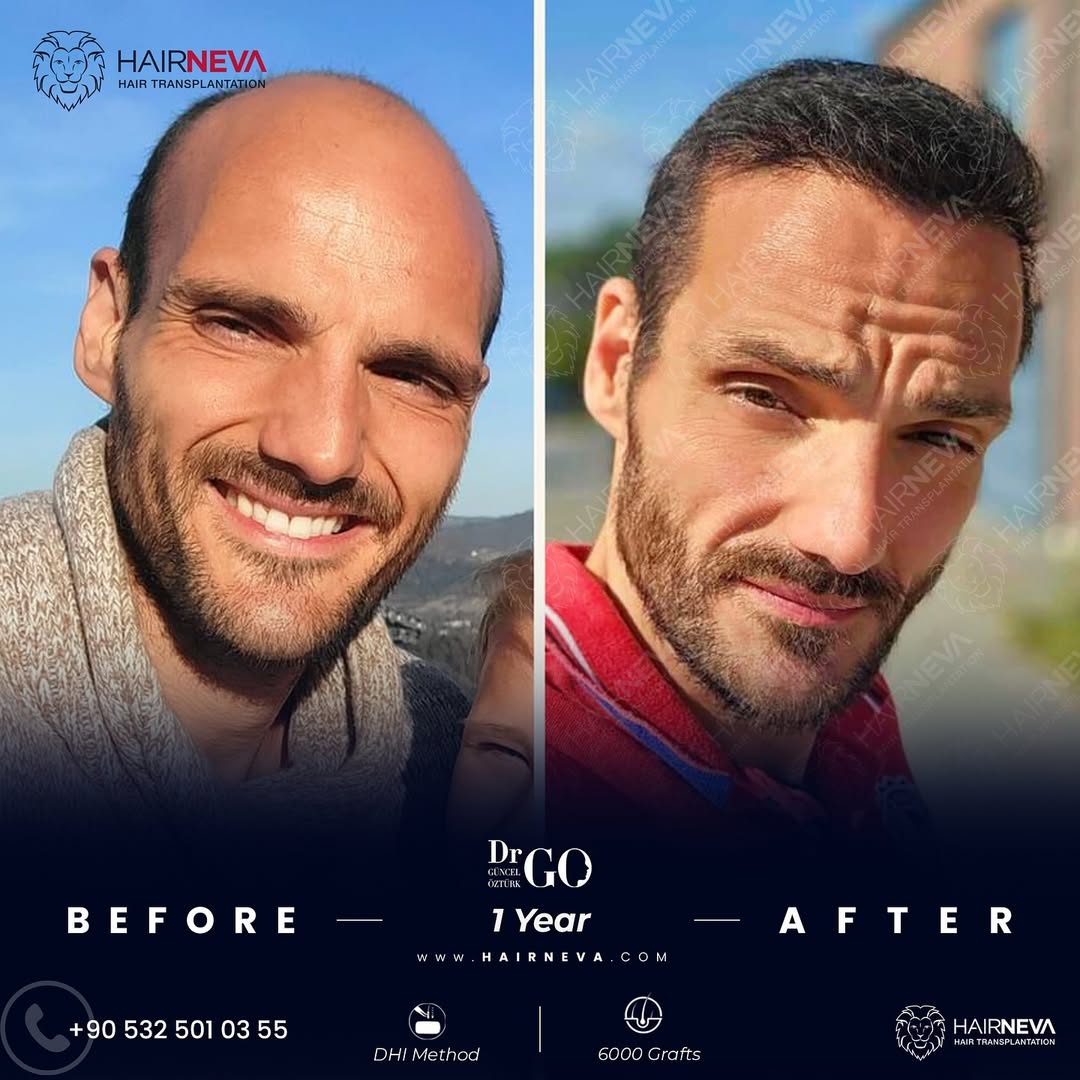 DHI Hair Transplant in Turkey
