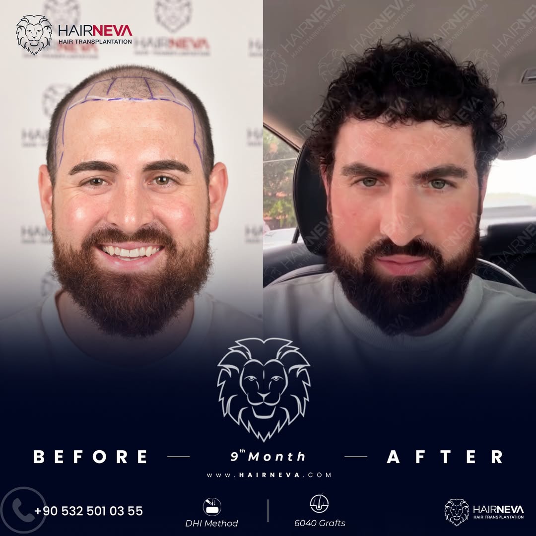 DHI Hair Transplant in Turkey