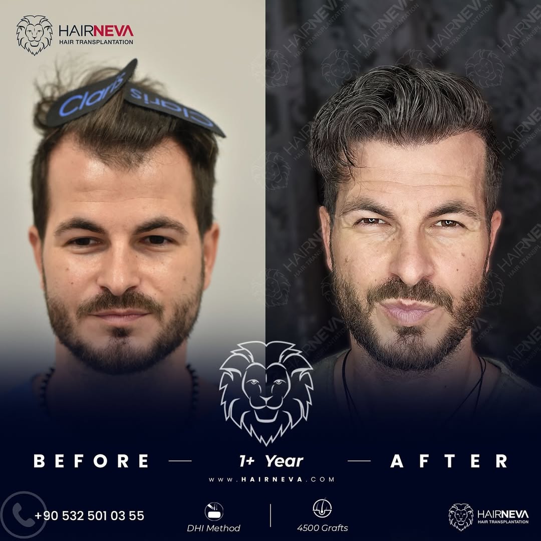 Unshaven Hair Transplant in Turkey