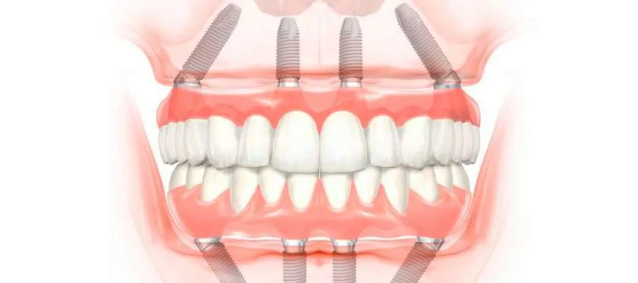 Removable Prosthesis