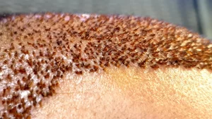 After Hair Transplant Scabs 1 After Hair Transplant Scabs