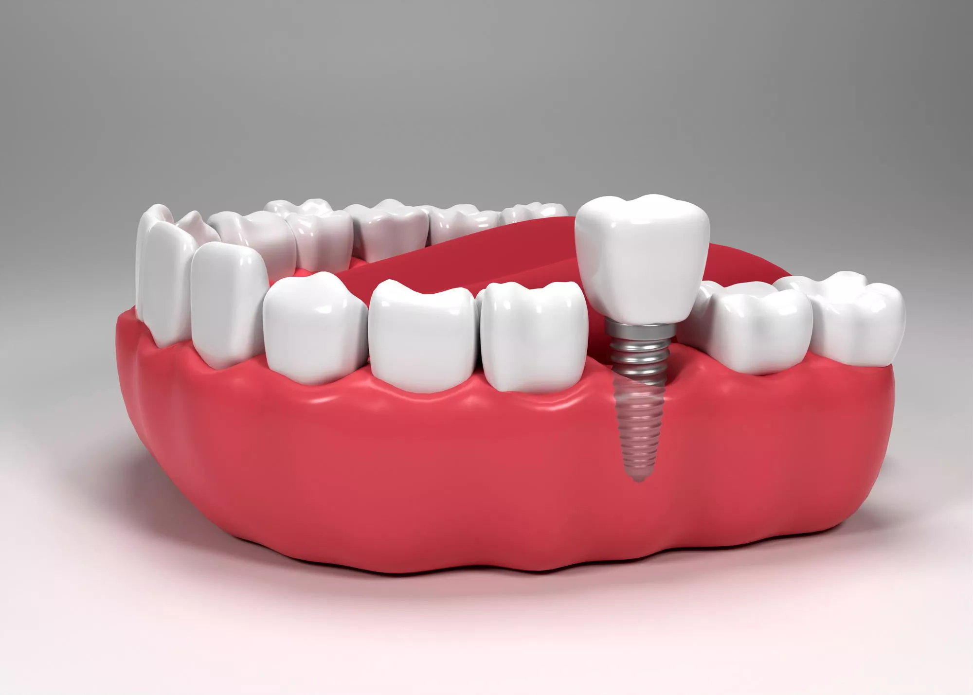 dental-implants-turkeyy