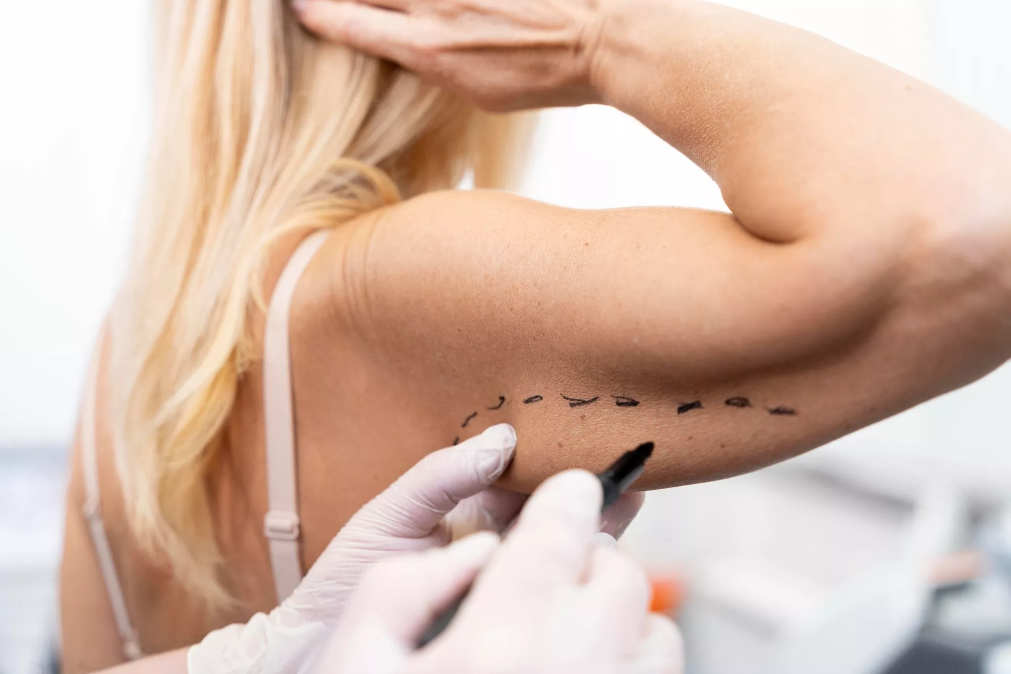 upper-arm-aesthetics